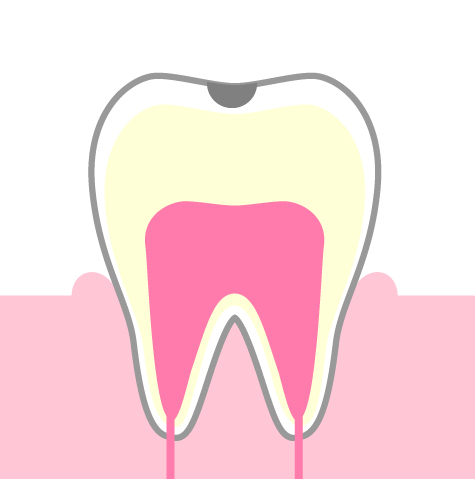 C1：エナメル質内の虫歯