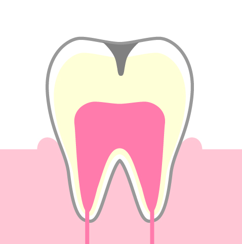 C2：象牙質に達した虫歯