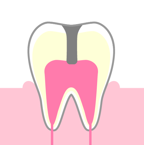 C3：歯髄(神経)に達した虫歯