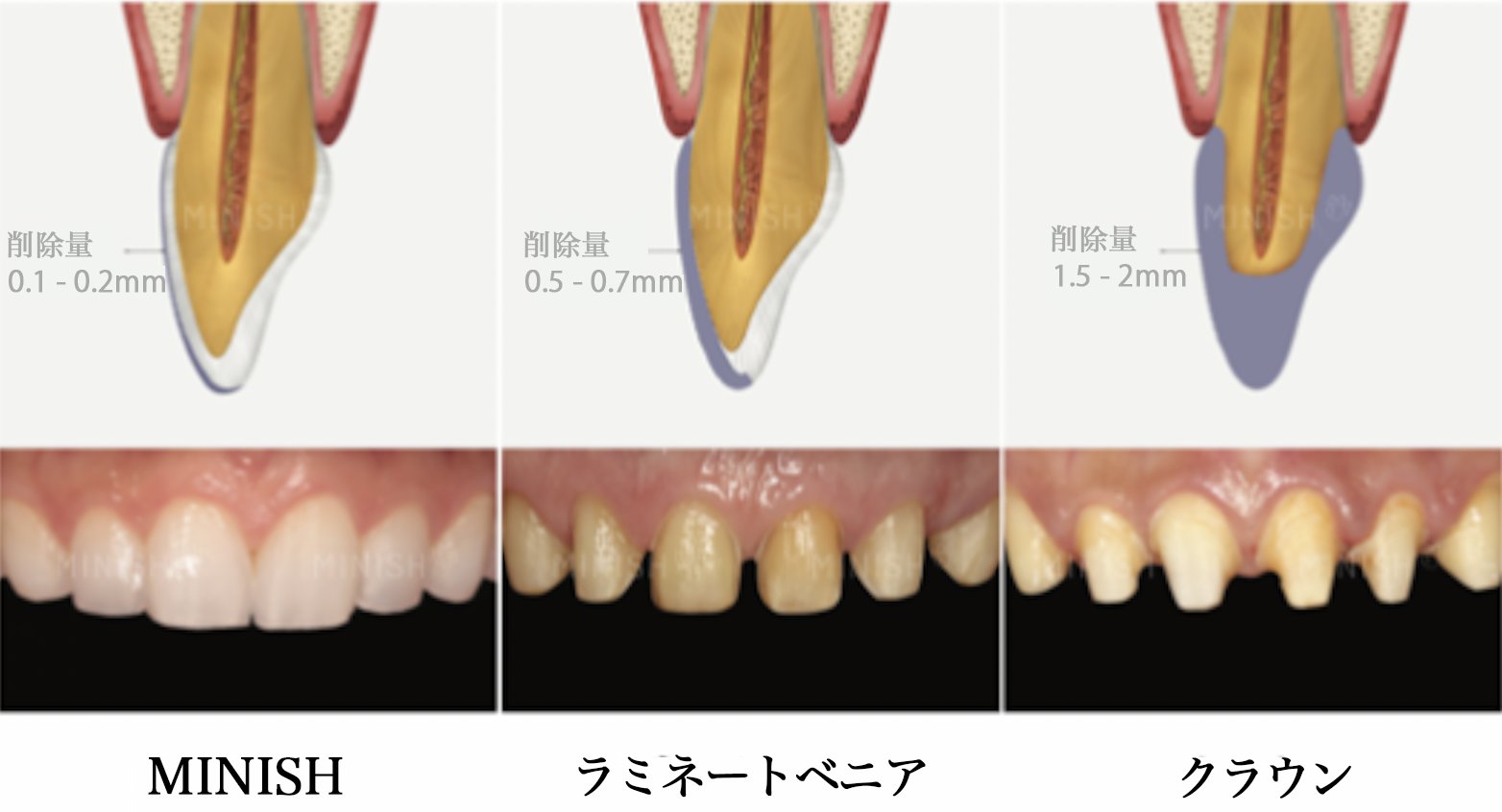 ミニッシュとは